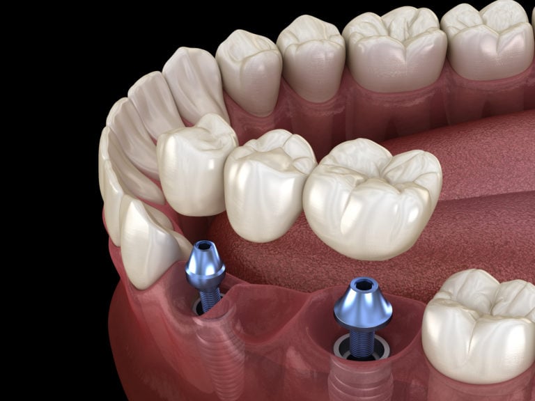 dental bridges near me