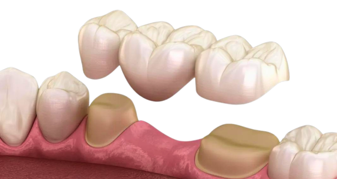 dental bridges south edmonton