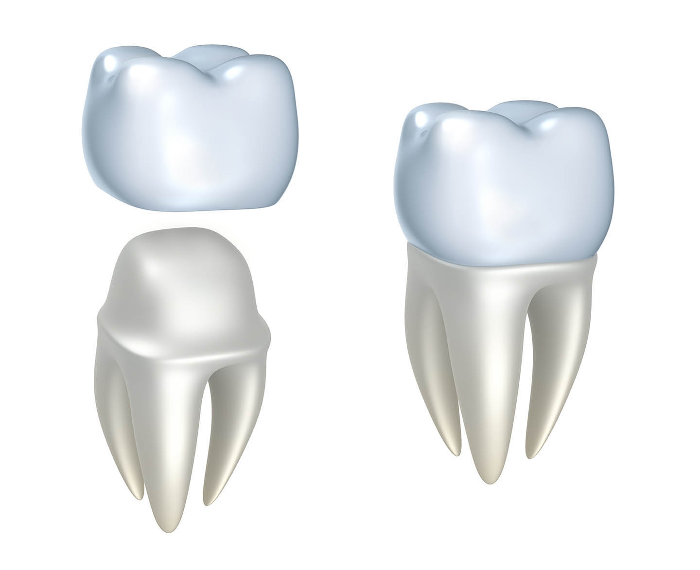 dental crowns near me