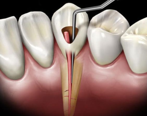 root canal therapy near me