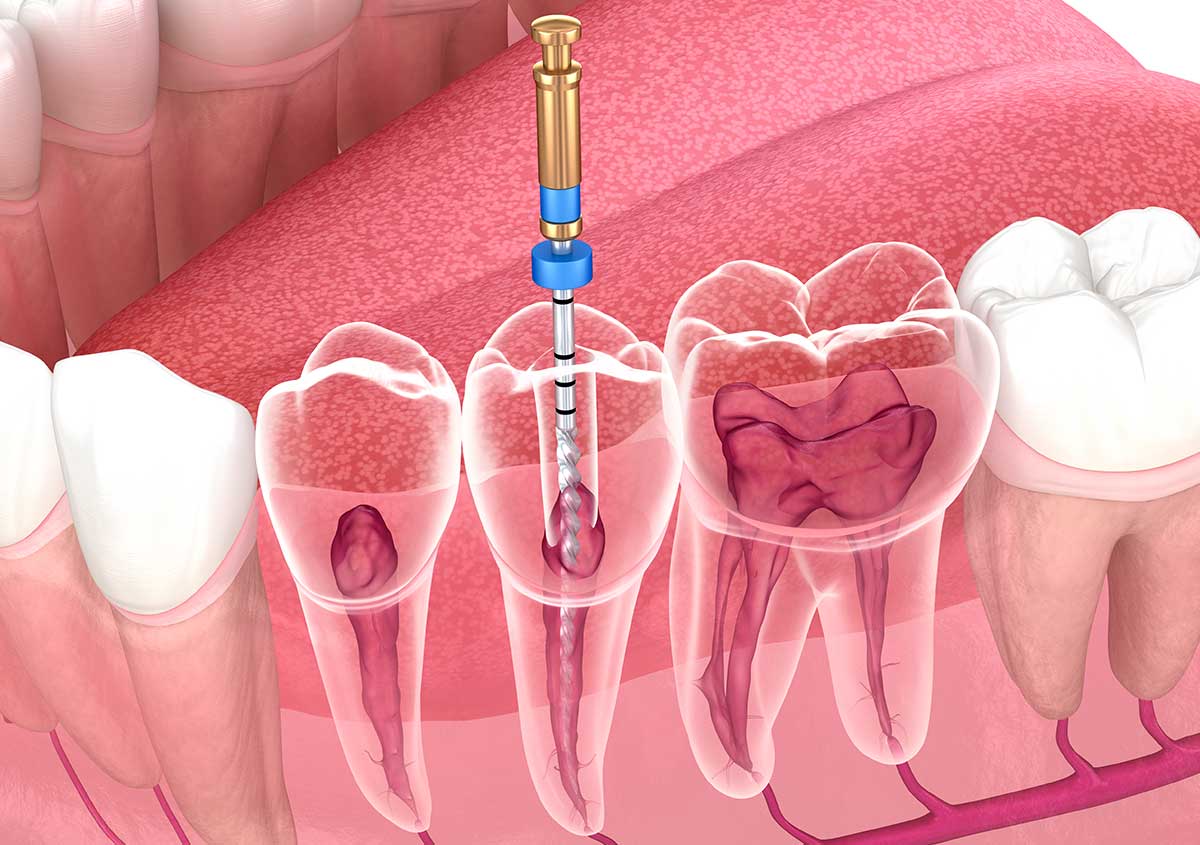 root canal therapy south edmonton