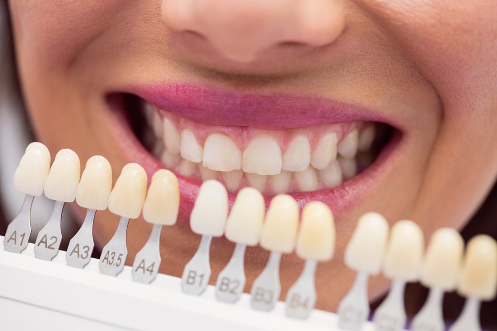 Porcelain Veneers Procedure Step By Step